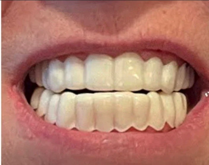Veneers